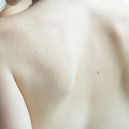 Jak powiedzieć partnerowi o trądziku na plecach? Zasady pielęgnacji skóry z niedoskonałościami 